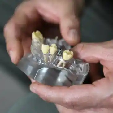 Molde Implantes Implantes dentales